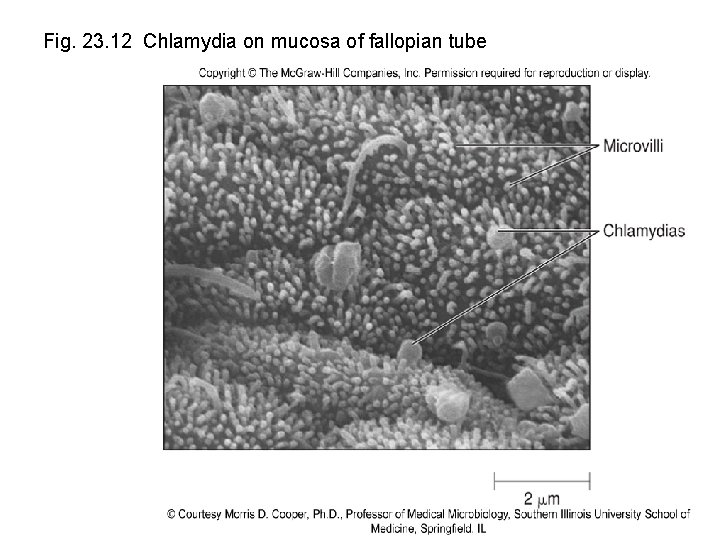 Fig. 23. 12 Chlamydia on mucosa of fallopian tube 