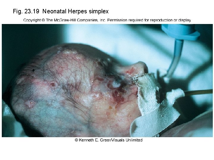 Fig. 23. 19 Neonatal Herpes simplex 