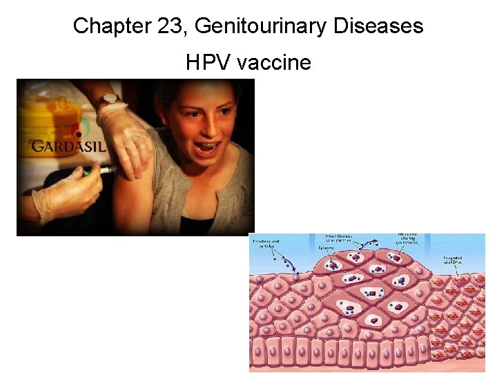 Chapter 23, Genitourinary Diseases HPV vaccine 