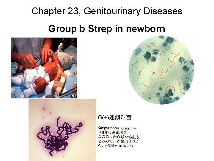 Chapter 23, Genitourinary Diseases Group b Strep in newborn 