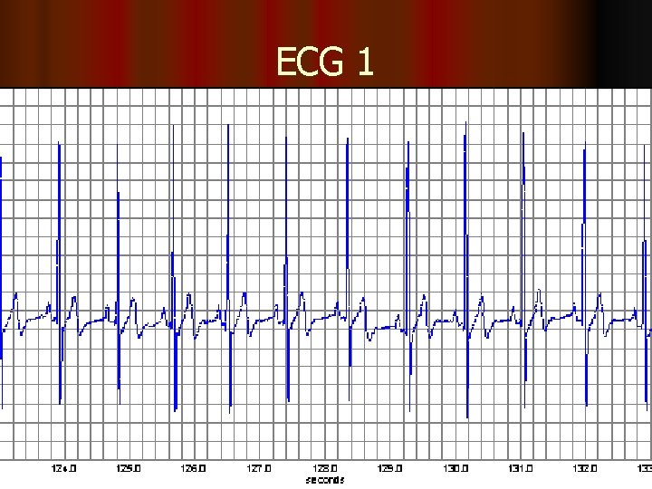 ECG 1 