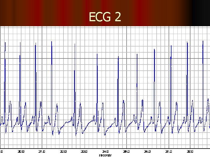 ECG 2 