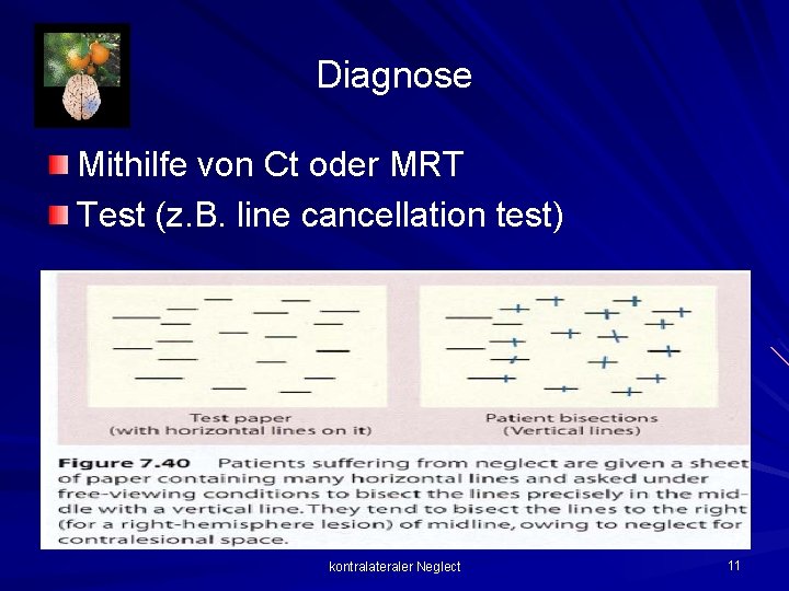 Diagnose Mithilfe von Ct oder MRT Test (z. B. line cancellation test) kontralateraler Neglect