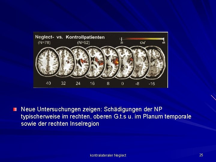 Neue Untersuchungen zeigen: Schädigungen der NP typischerweise im rechten, oberen G. t. s u.