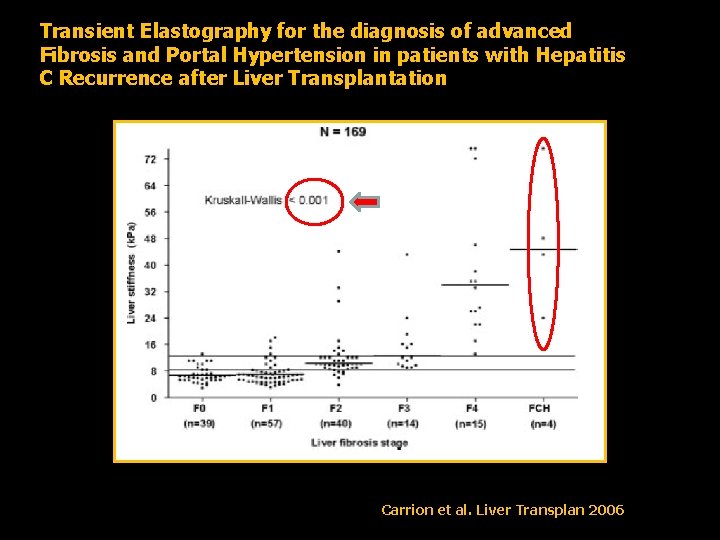 Transient Elastography for the diagnosis of advanced Fibrosis and Portal Hypertension in patients with