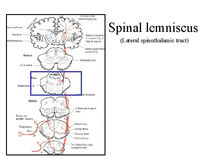 Spinal lemniscus (Lateral spinothalamic tract) Spinal lemniscus (Lateral spinothalamic tract)