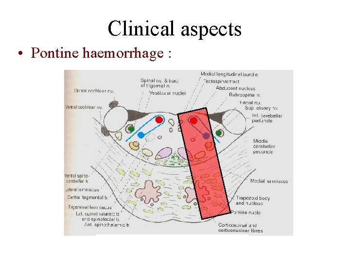 Clinical aspects • Pontine haemorrhage : Clinical aspects • Pontine haemorrhage :