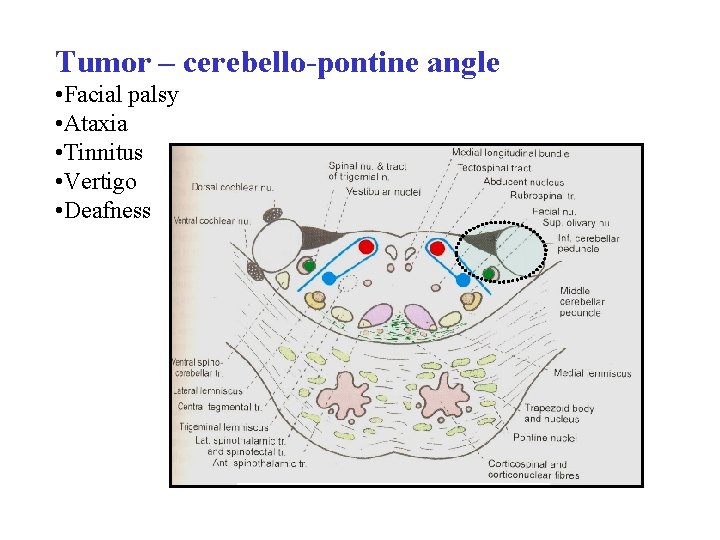 Tumor – cerebello-pontine angle • Facial palsy • Ataxia • Tinnitus • Vertigo • Tumor – cerebello-pontine angle • Facial palsy • Ataxia • Tinnitus • Vertigo •