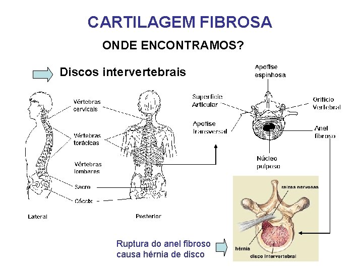 CARTILAGEM FIBROSA ONDE ENCONTRAMOS? Discos intervertebrais Ruptura do anel fibroso causa hérnia de disco CARTILAGEM FIBROSA ONDE ENCONTRAMOS? Discos intervertebrais Ruptura do anel fibroso causa hérnia de disco