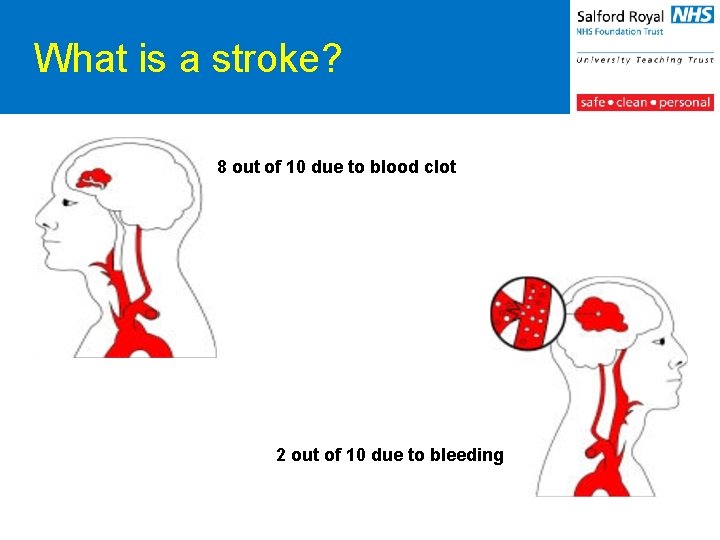 What is a stroke? 8 out of 10 due to blood clot 2 out