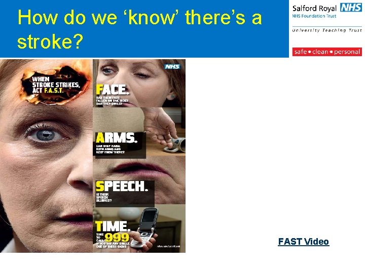 How do we ‘know’ there’s a stroke? FAST Video 