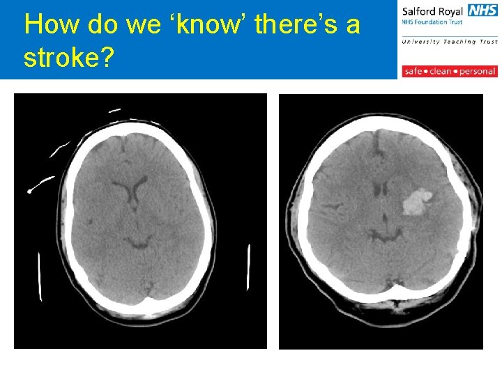 How do we ‘know’ there’s a stroke? 