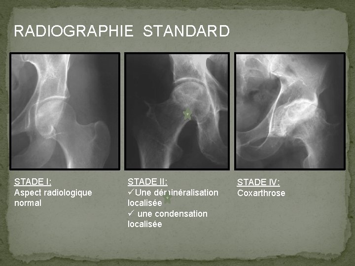 RADIOGRAPHIE STANDARD STADE I: Aspect radiologique normal STADE II: üUne déminéralisation localisée ü une