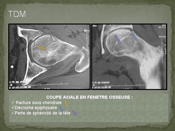 TDM COUPE AXIALE EN FENETRE OSSEUSE : ü fracture sous chondrale üDécroché épiphysaire üPerte