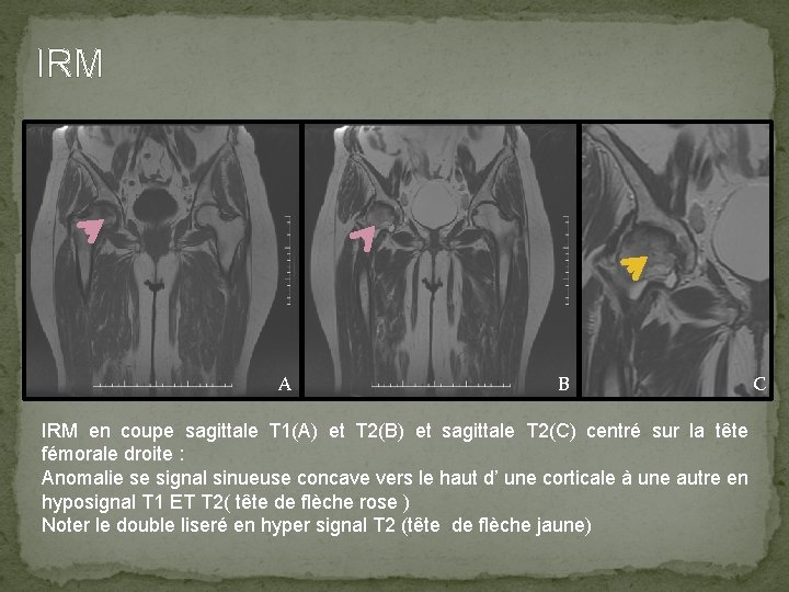 IRM A B C IRM en coupe sagittale T 1(A) et T 2(B) et