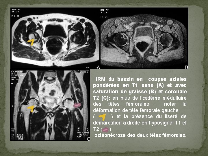 A C B IRM du bassin en coupes axiales pondérées en T 1 sans
