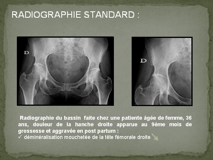 RADIOGRAPHIE STANDARD : Radiographie du bassin faite chez une patiente âgée de femme, 36