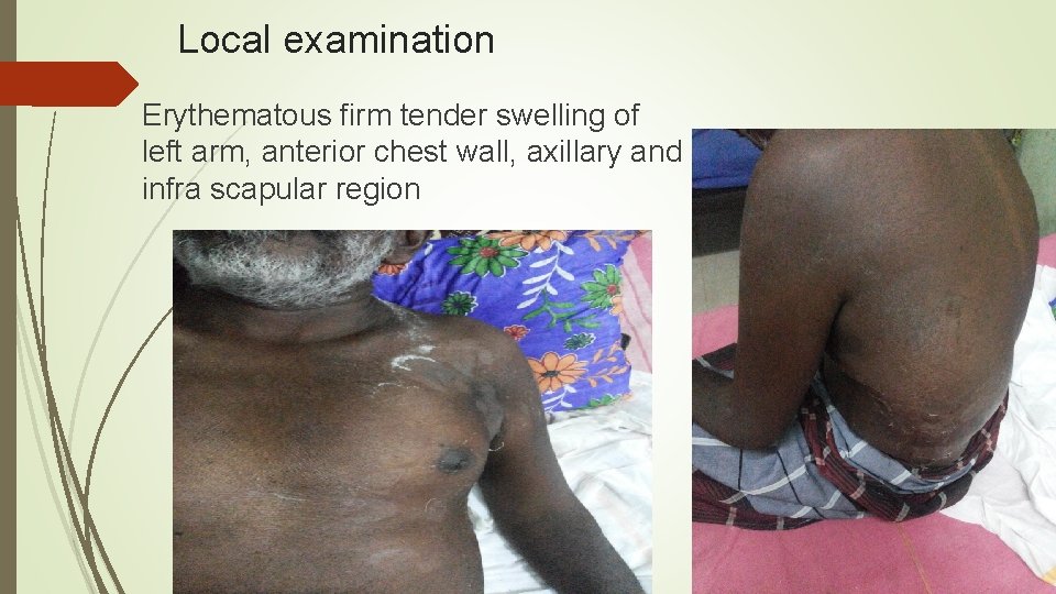 Local examination Erythematous firm tender swelling of left arm, anterior chest wall, axillary and