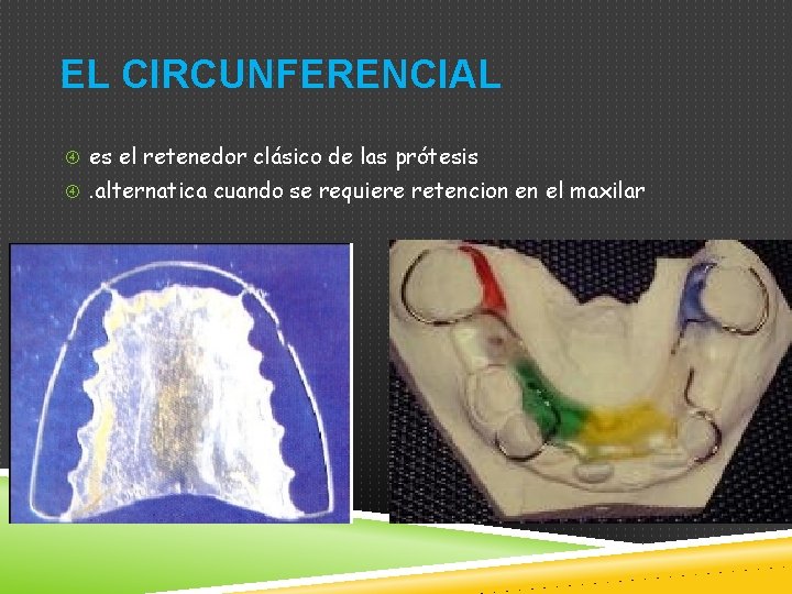 EL CIRCUNFERENCIAL es el retenedor clásico de las prótesis . alternatica cuando se requiere