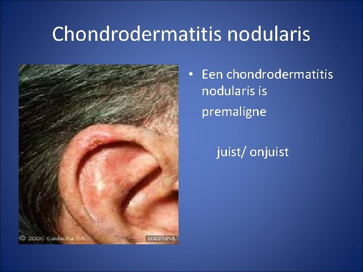 Chondrodermatitis nodularis • Een chondrodermatitis nodularis is premaligne juist/ onjuist 