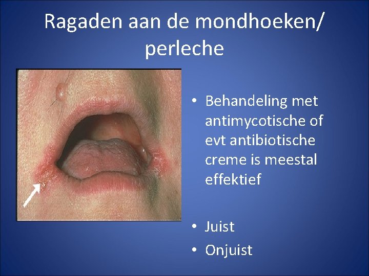 Ragaden aan de mondhoeken/ perleche • Behandeling met antimycotische of evt antibiotische creme is