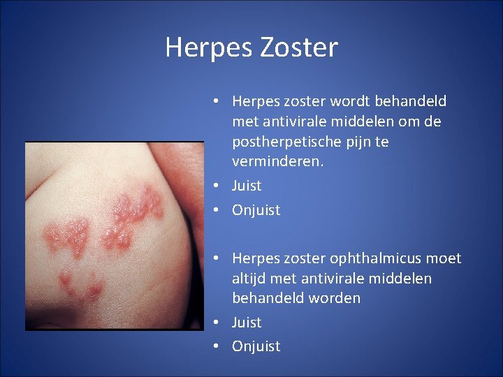 Herpes Zoster • Herpes zoster wordt behandeld met antivirale middelen om de postherpetische pijn