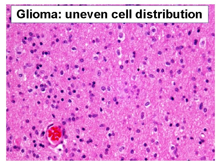 Glioma: uneven cell distribution 