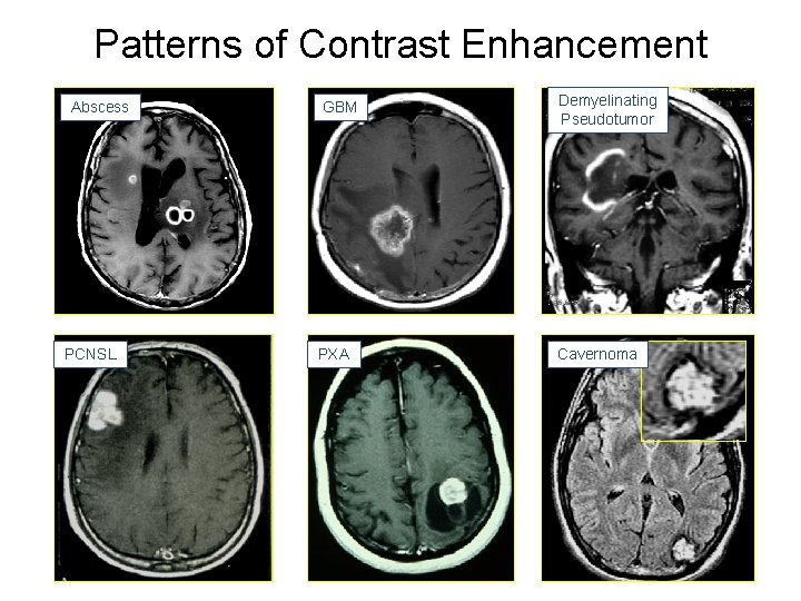 Patterns of Contrast Enhancement Abscess PCNSL GBM Demyelinating Pseudotumor PXA Cavernoma 