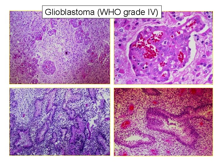 Glioblastoma (WHO grade IV) 