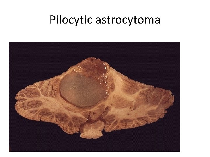 Pilocytic astrocytoma 