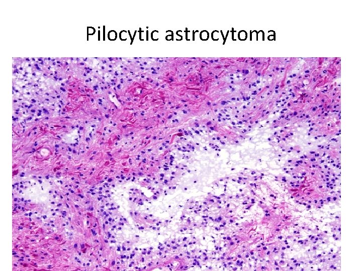 Pilocytic astrocytoma 