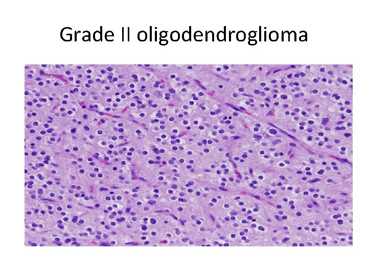 Grade II oligodendroglioma 
