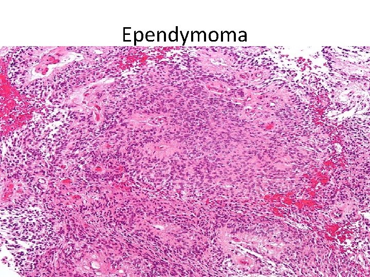 Ependymoma 