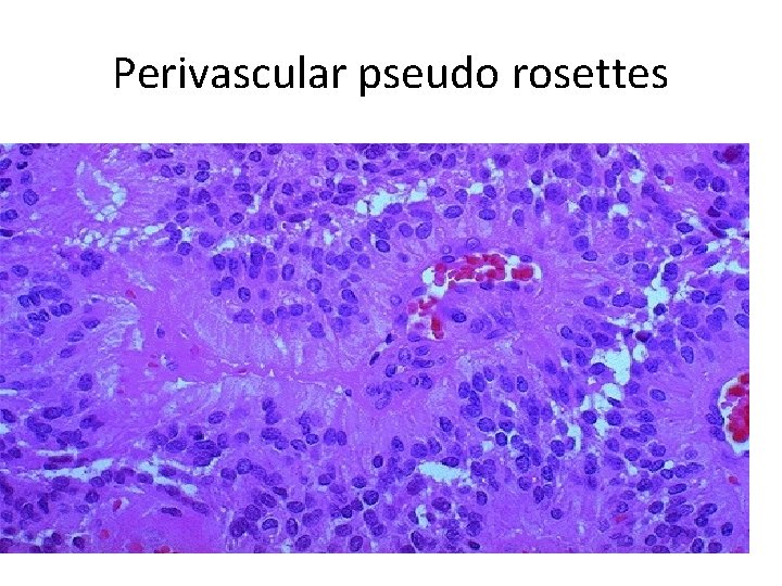 Perivascular pseudo rosettes 