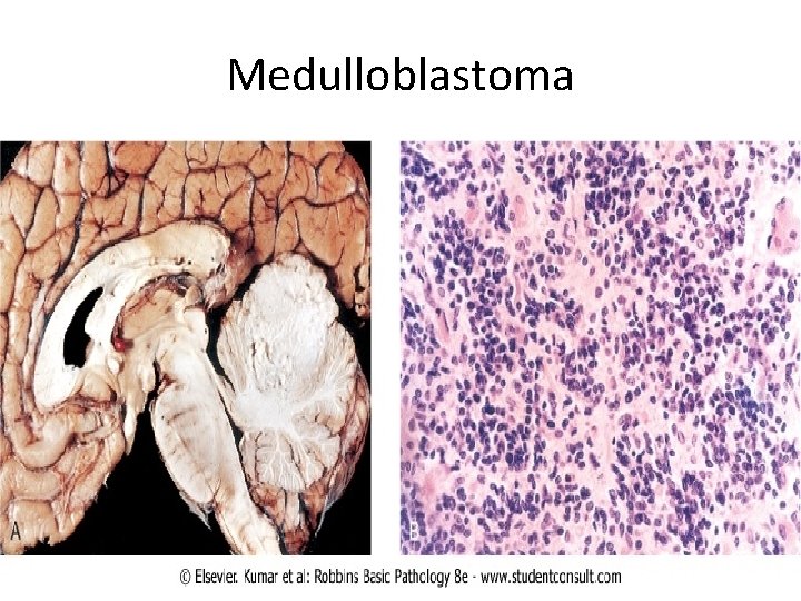 Medulloblastoma 