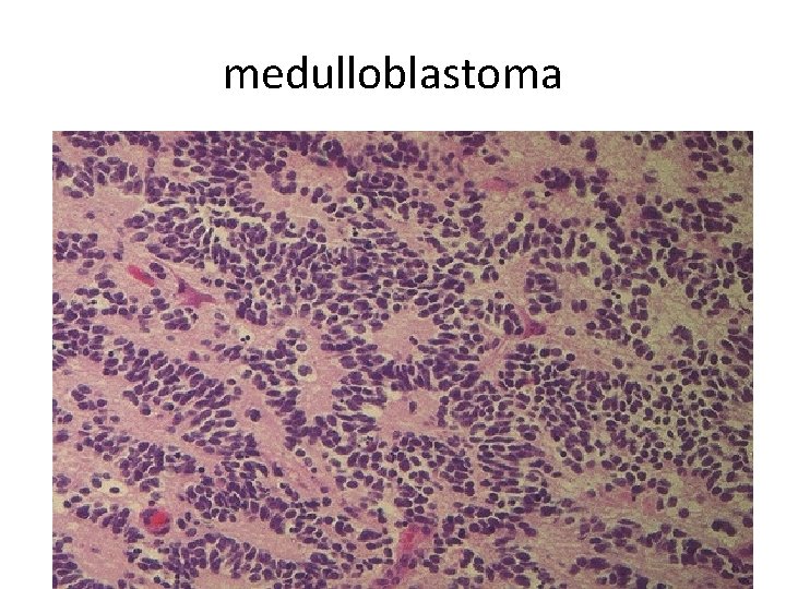 medulloblastoma 