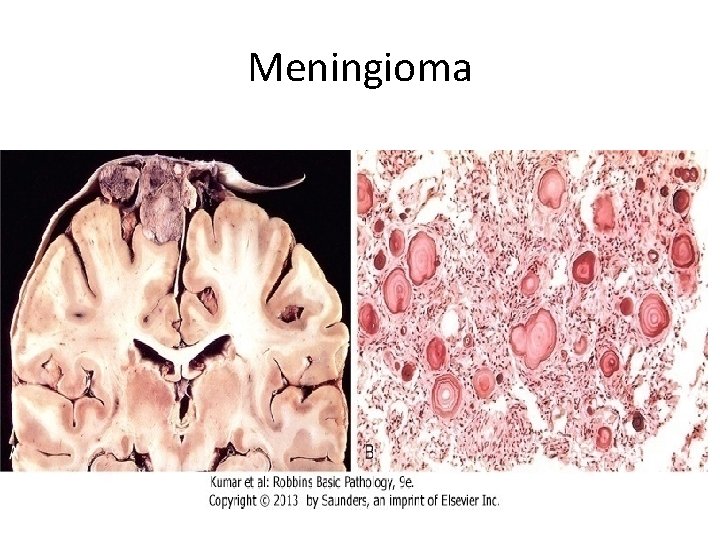 Meningioma 