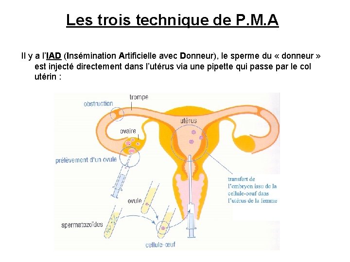 Les trois technique de P. M. A Il y a l’IAD (Insémination Artificielle avec
