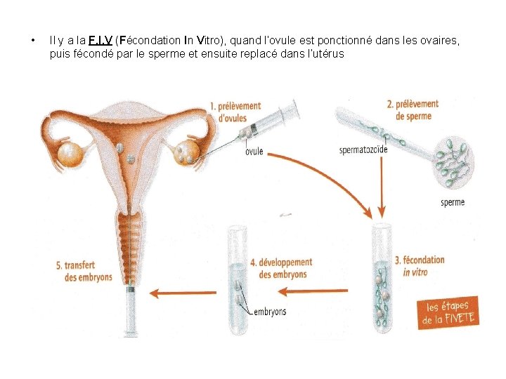  • Il y a la F. I. V (Fécondation In Vitro), quand l’ovule