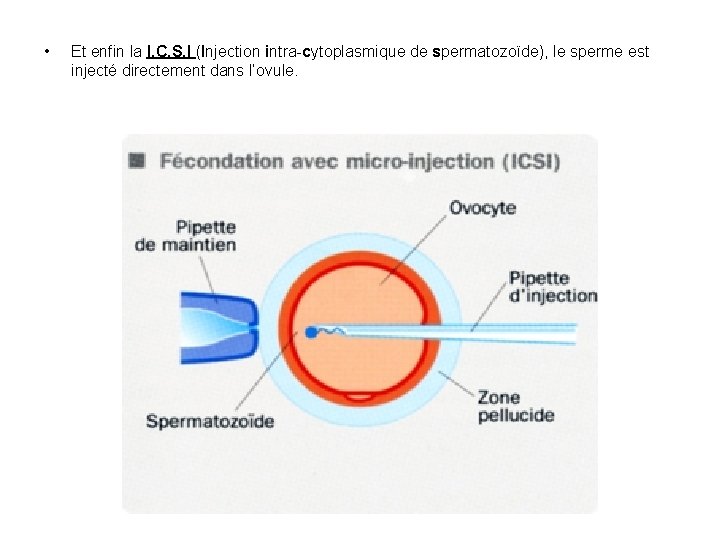  • Et enfin la I. C. S. I (Injection intra-cytoplasmique de spermatozoïde), le