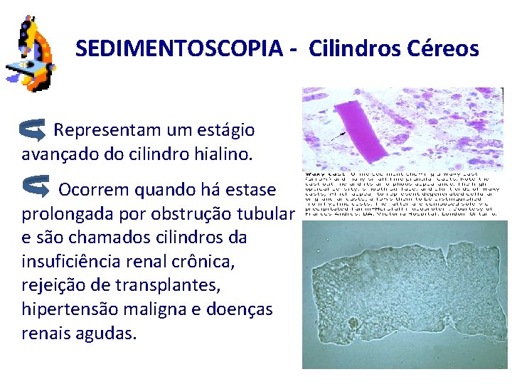 SEDIMENTOSCOPIA - Cilindros Céreos Representam um estágio avançado do cilindro hialino. Ocorrem quando há