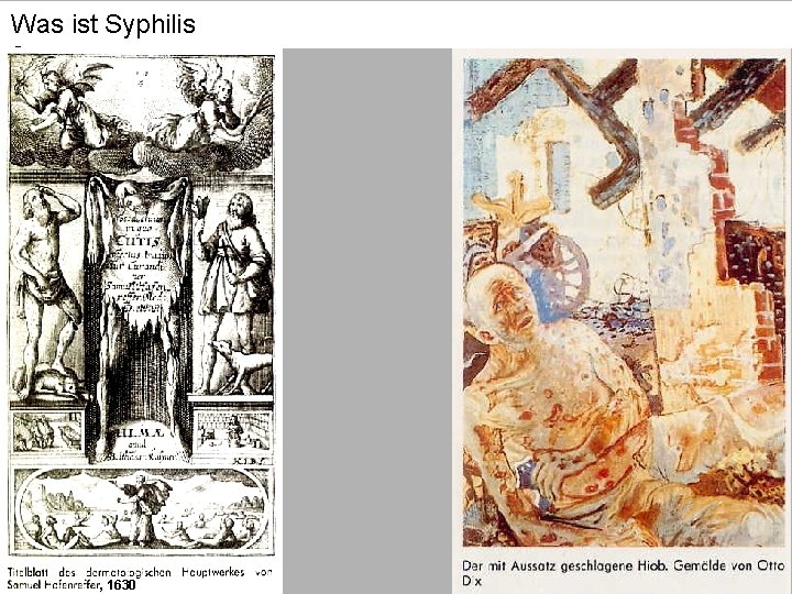 Was ist Syphilis ? , 1630 