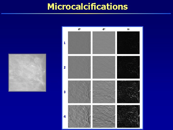 Microcalcifications dv 1 2 3 4 do m 