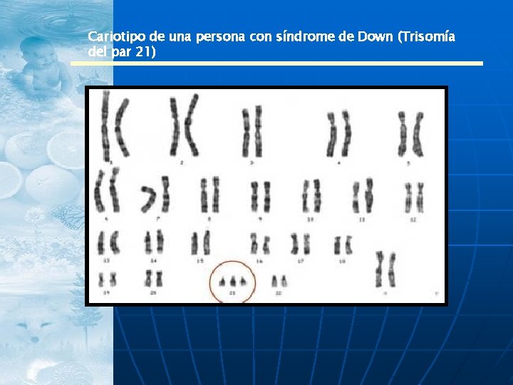 Cariotipo de una persona con síndrome de Down (Trisomía del par 21) 