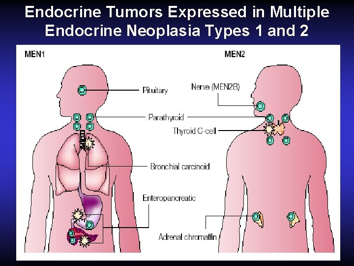 Endocrine Tumors Expressed in Multiple Endocrine Neoplasia Types 1 and 2 Endocrine Tumors Expressed in Multiple Endocrine Neoplasia Types 1 and 2