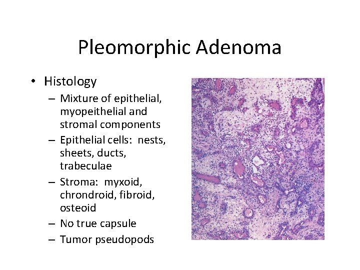 Pleomorphic adenoma histology drawing, Prosztata adenoma rák 3. fokozatú kezelés