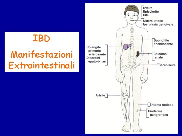 IBD Manifestazioni Extraintestinali 