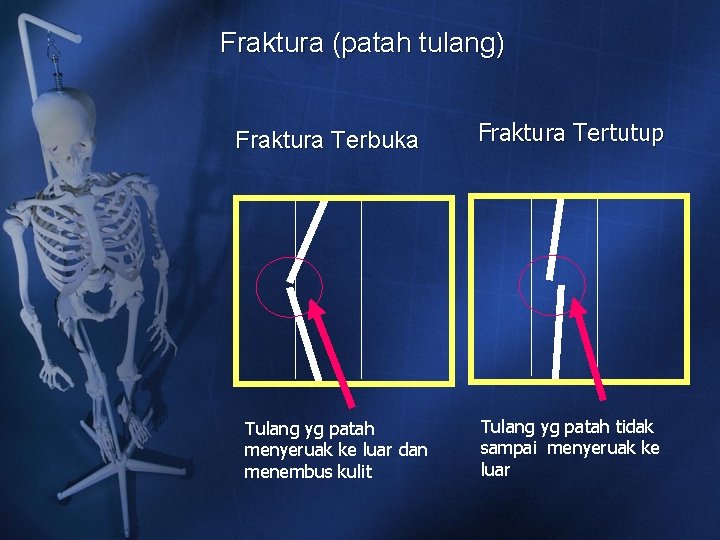 Fraktura (patah tulang) Fraktura Terbuka Tulang yg patah menyeruak ke luar dan menembus kulit Fraktura (patah tulang) Fraktura Terbuka Tulang yg patah menyeruak ke luar dan menembus kulit