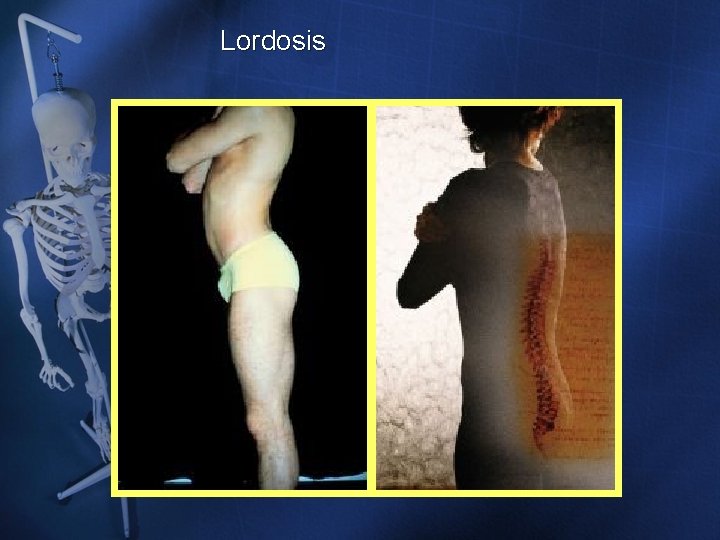 Lordosis Lordosis
