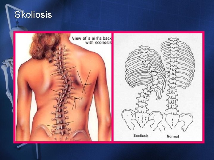 Skoliosis Skoliosis